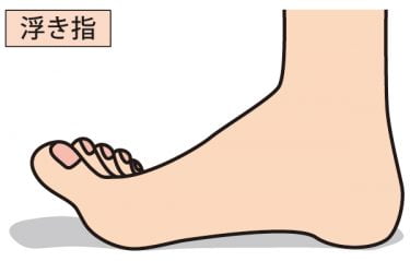 浮き指