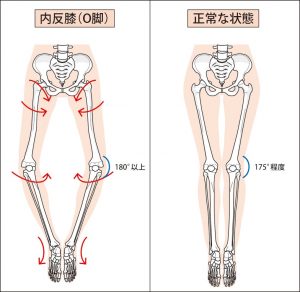 O脚の脚と正常の脚の比較