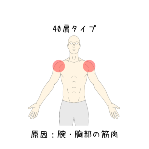 肩こりの原因は腕・胸部の筋肉