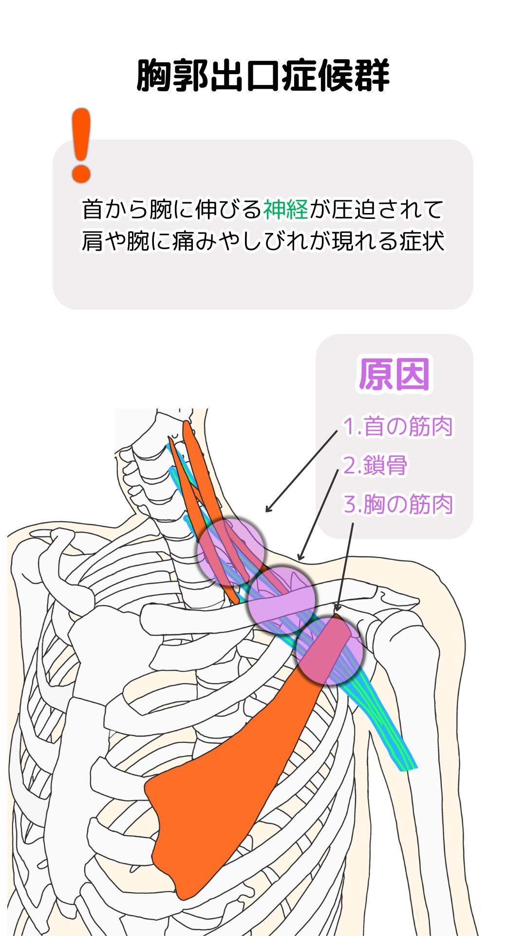 胸郭出口症候群 首から鎖骨: 胸口出口症候群 | 静岡市で胸郭出口症候群の「激痛」にお悩みの方へ – FCWFLB